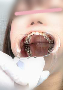 Gcolle未公開！壮絶銀歯娘さきちゃんの歯　クリーニングと歯型