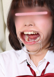 ミクちゃんの歯　インレーと治療痕とデンタルフロス