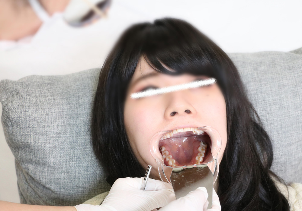 Teeth of Reiko　Decay?
