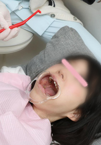 すみれちゃんの銀歯と欠損　後編　「歯医者行ったら全部銀歯に・・・」　