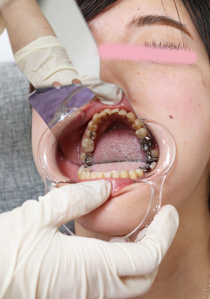 Teeth of Chiaki　Toothless　Amalgam　Silver Crowns　Silver Teet　Rotting Teeth　Dental Fetish