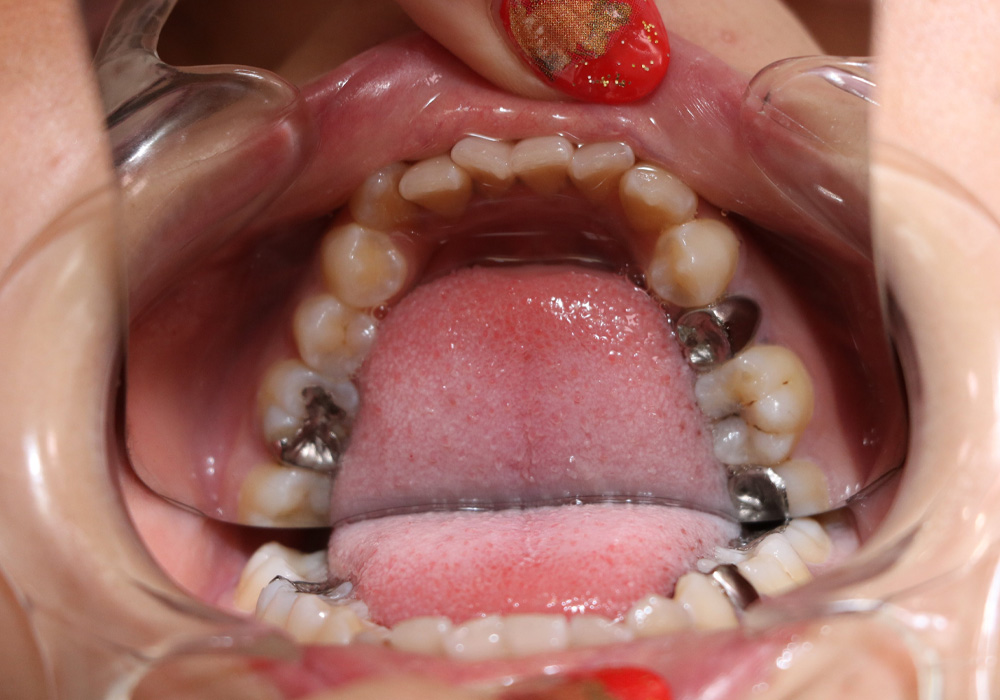 沙希ちゃんの歯　虫歯何本有ると思ってるの？