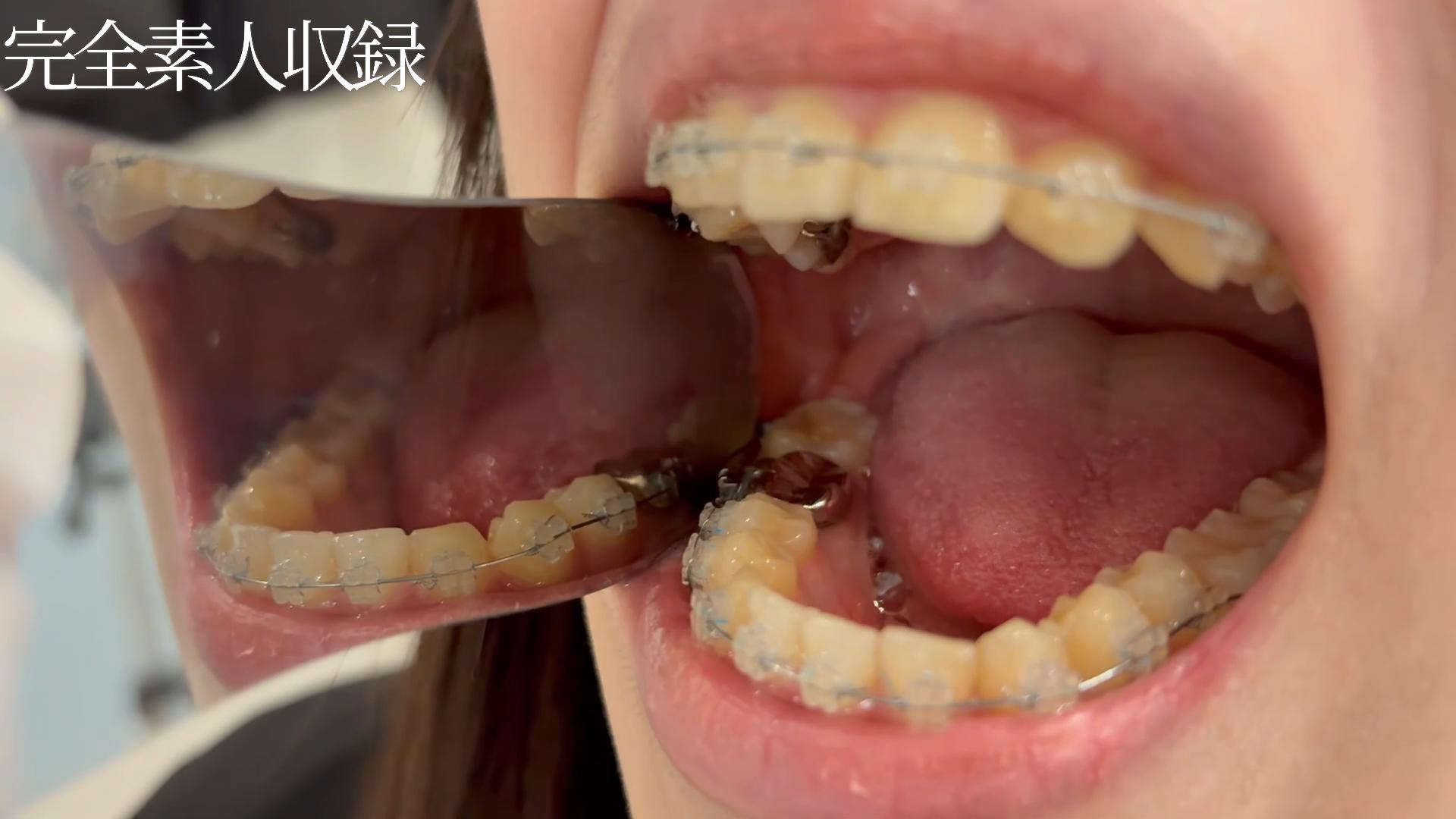 【委託作品】矯正器具＋銀歯の身長156cm・18歳。小生意気な態度での初検診記録