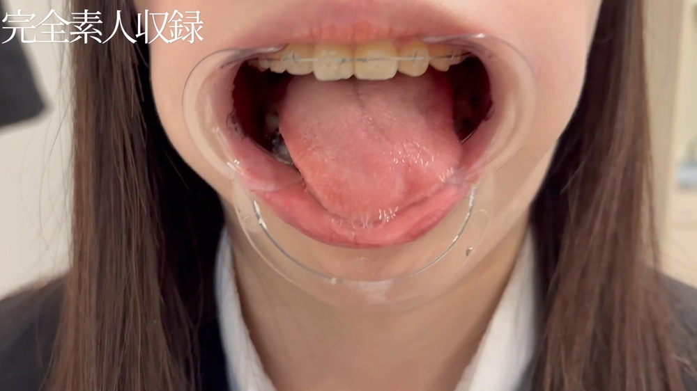 【委託作品】矯正器具＋銀歯の身長156cm・18歳。小生意気な態度での初検診記録