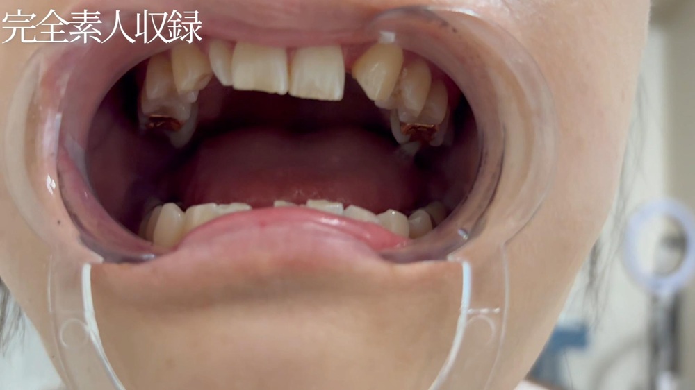 【委託作品】これが見れるのは奇跡です。金歯の20歳を余すとこなく完全収録。