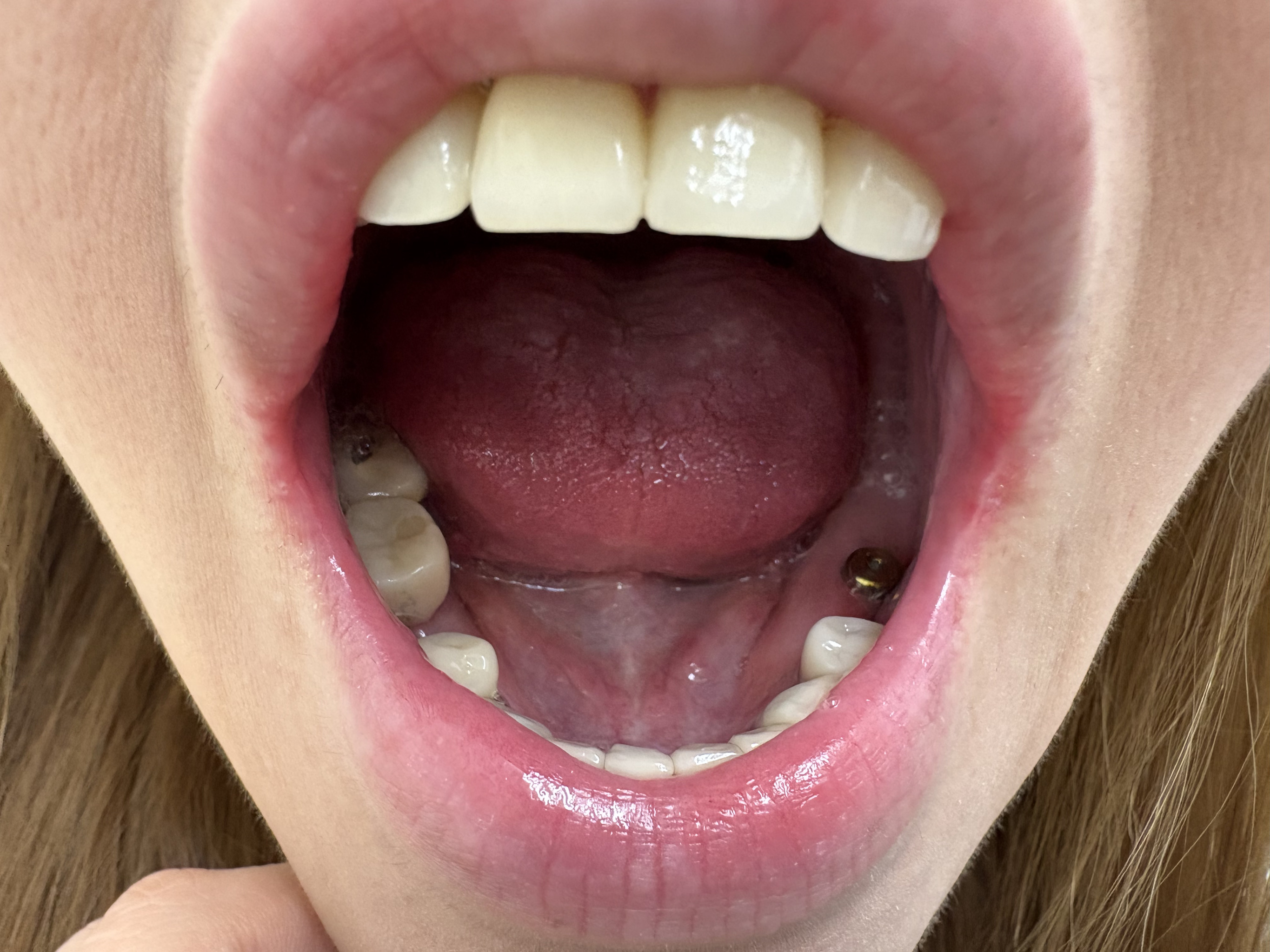 【委託作品】インプラントのリアル。某銀座有名店No1の20歳Hカップキャバ嬢さんの口の中を拝見。